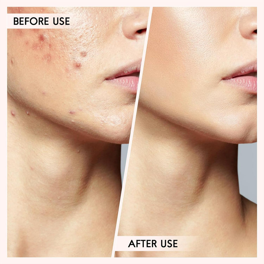 Mee-eter & Puist Eltávolító Készlet